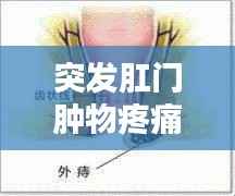 突发肛门肿物疼痛，症状解析、诱因与治疗方法全攻略